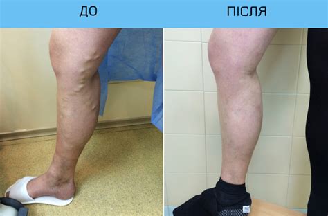 Лечение варикоза на ногах с помощью лазерной технологии